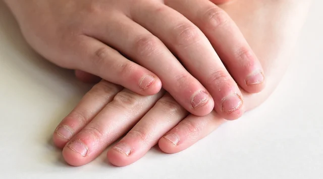 علت ناخن جویدن کودکان